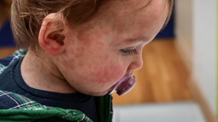 Visuel d'un enfant ayant la rougeole