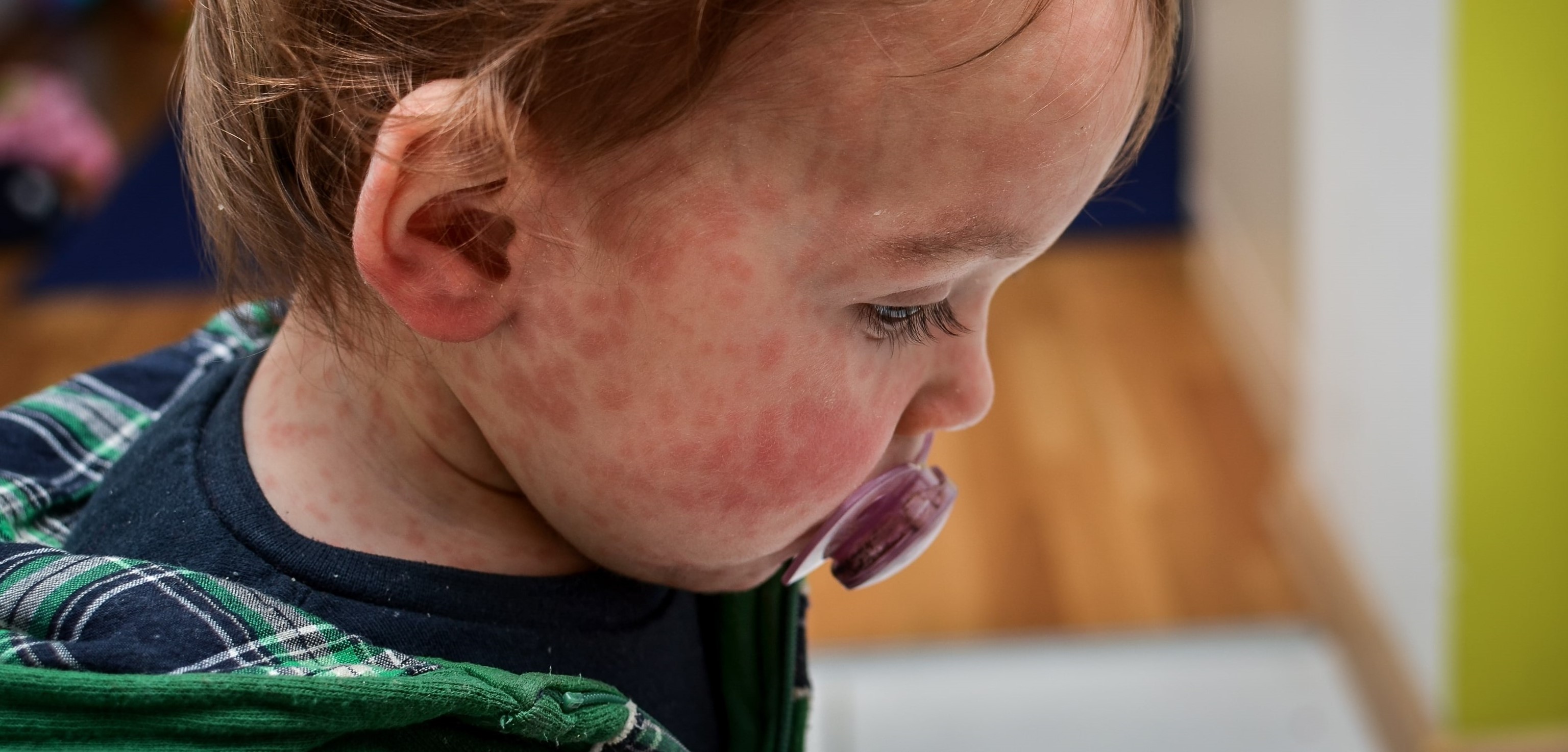 Rougeole en France : une quasi-absence de circulation du virus maintenue en 2022